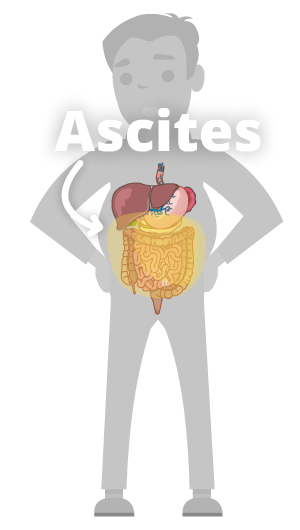 Ascites (fluid in the abdomen) - Cirrhosis Care
